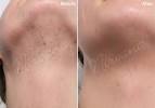 Home Laser Hair Removal Before And After