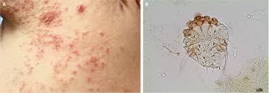 Image result for skin rash similar to scabies
