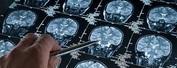 How to check for brain tumor. Skull Base Tumors Johns Hopkins Medicine