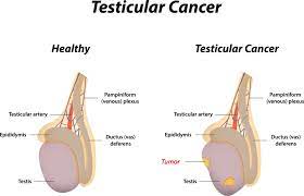 Testicular Cancer | Home Health Uk