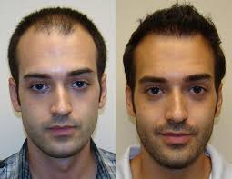 Low-cost Hair Transplant in North Carolina Madison Rollins