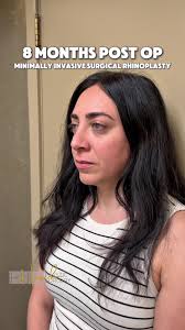 Minimally Invasive Rhinoplasty Results After 8 Months