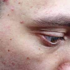 Come togliere i brufoli velocemente dal viso e magari in modo anche naturale? Acne Cause E Rimedi Paginemediche