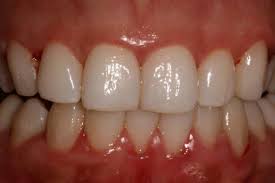 Tooth decay, gum disease, receding gums, bleeding gums gum disease is an epidemic. Gum Disease Pictures What Do Healthy Gums Look Like