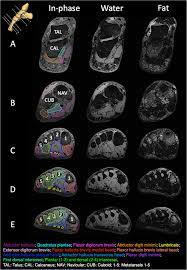 As a result, during walking the body's center of gravity normally fluctuates only 5cm in both vertical and lateral directions. New Insights Into Intrinsic Foot Muscle Morphology And Composition Using Ultra High Field 7 Tesla Magnetic Resonance Imaging Bmc Musculoskeletal Disorders Full Text