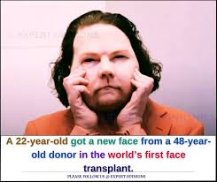 First double arm and shoulder transplant