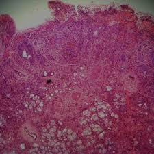 Maybe you would like to learn more about one of these? Pdf Necrotizing Sialometaplasia Of Palate With Belligerent Clinical Stance A Case Report And Review