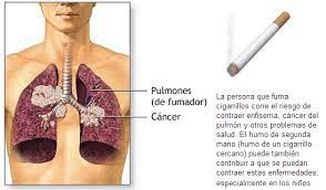 Se produce por el endurecimiento y engrosamiento de la piel de la fascia palmar que es la envoltura de la mano que existe justo por. Enfermedades Del Fumador