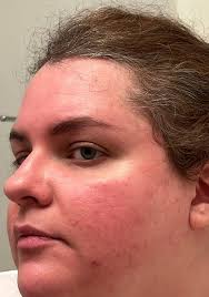 Looking for any personal experiences with using Accutane (good or bad). I'm  almost 40 and still have terrible acne so considering trying this, but  hesitant because of the potential side effects.