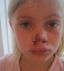 Mum's call for help to back up legal fight after daughter injured by  skateboarder