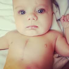 Complete Atrioventricular Canal Defect: Keaton's Story