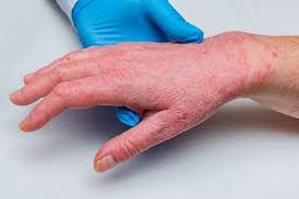 Jan 25, 2021 · psoriatic arthritis shares many symptoms with several other arthritic conditions, such as ankylosing spondylitis, reactive arthritis, and arthritis associated with crohn's disease and ulcerative colitis. Clinical Challenges Treatment Of Psoriatic Arthritis Medpage Today