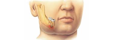 Mai stresant decat a stii ca ai o problema ste intrebare: InfecÈ›ii Dentare Cum Le RecunoÈ™ti È™i Ce Faci Pentru A Preveni InfecÈ›ia
