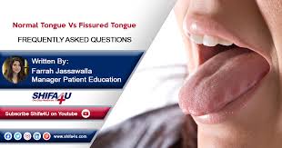 Image result for Fissured tongue
