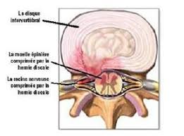 Risulta composto dalla sovrapposizione verticale di 7 vertebre. Chirurgie Spinale Cervicale Par Approche Anterieure Chu De Quebec Universite Laval