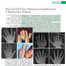 Image result for Polydactyly