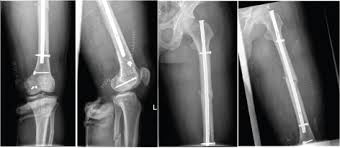 Check spelling or type a new query. Open Medial Hoffa Fracture With Ipsilateral Femoral Shaft Fracture Case Report