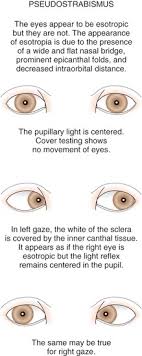 Epicanthal folds are skin folds that may cover the inside corners of the eye. Ophthalmology Obgyn Key
