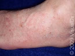 Image result for scabies human bites
