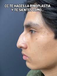 Recuperación de Rinoplastia de Preservación Ultrasonica en Perú