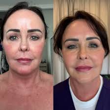 Have you ever wondered what it's like to recover from a BBL & Moxi  treatment? Keep an eye for daily updates of Dr Leanne's recovery ⏳👀 Day 1-  Leanne's skin is feeling