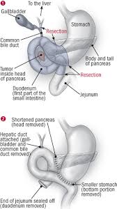 The Whipple Procedure Harvard Health
