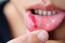 Image result for oral thrush symptoms roof of the mouth