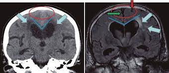 Cerebral Atrophy Wikipedia