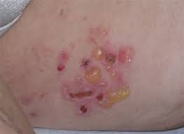 Image result for Pemphigoid