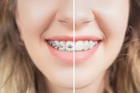 Once the brackets and the wires are removed, your teeth may feel slimy and a little strange. Before And After Braces Orthodontic Services Johns Creek Ga