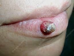 Image result for Pyogenic Granuloma