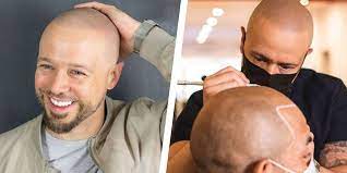 The result is a distinct confusion and ambiguity when linked to this contemporary and innovative treatment. Hairline Tattooing And What You Need To Know