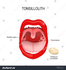 Image result for Tonsillolith