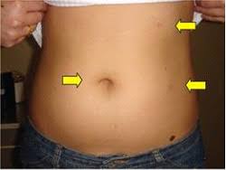 Kidney Health Kidney Cancer Treatment Singapore Advanced Urology