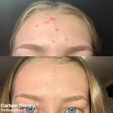 Tea tree oil needs to be diluted to ~5% concentration before you put it on your face so usually even a drop is too much for one use. 6 Reason S Why You Need To Try Carbon Theory S Acne Soap Beauty Bay Edited