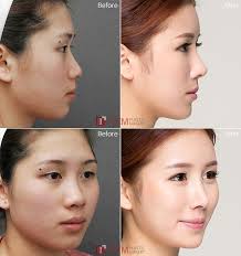 Korean Face Plastic Surgery Chin Lips And Nose Before And After Plastic Surgery Face Plastic Surgery Face