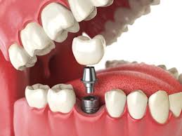 Image result for dental implant