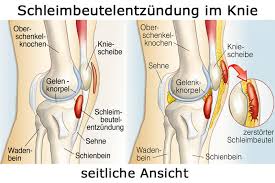 Schleimbeutelentzundung Bursitis Gesund Co At