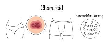 Image result for chancroid