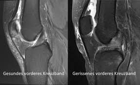 Direkt nach dem kreuzbandriss entstehen als erste symptome eine schwellung sowie schmerzen im knie. Hessing Klinik Fur Sportorthopadie Schwerpunkt Kreuzbandriss