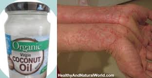 Why Coconut Oil Is One Of The Best Natural Remedies For Eczema Coconut Oil For Eczema Coconut Oil Oils For Eczema