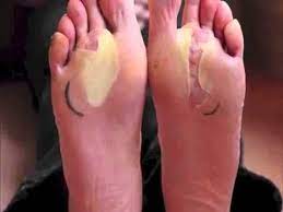 Como Curar Las Ampolla De Los Pies Curar Ampollas Remedios Para Las Ampollas Ampolleta