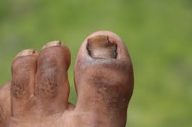 Image result for diabetic toes