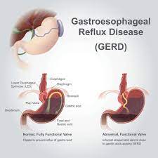 There S More To Heartburn Than You Think Gi Associates