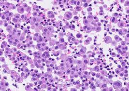 Cytological and anatomopathological aspects | find, read and cite all the research you need on researchgate Pathology Outlines Diffuse Malignant Mesothelioma