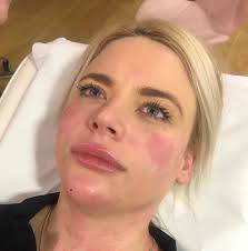 Botox and filler appointments available