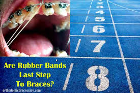 2 hours will ensure the procedure's been carried out just right. Are Rubber Bands Really Last Step To Braces Orthodontic Braces Care
