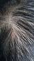 Seborrheic Dermatitis Folliculitis Scalp