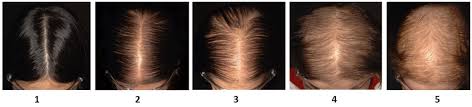 One of the most important roles of vitamin a is keeping hair follicles and the scalp moisturized. Vitamin D Supplements Improve Hair Regrowth In Patients With Diffuse Hair Loss Study