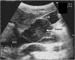 Egist Bdominal Ultrasonography Abdominal Ultrasonography Revealed An Abnormal Mass In The Infrahepatic Portion Which Tumor Ultrasound Ultrasound Sonography